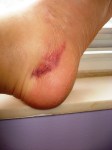 My ankle 10 days following STUPID